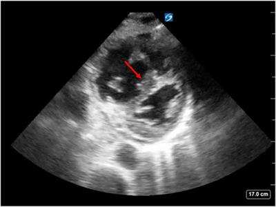 Cardiopulmonary interactions in left heart failure